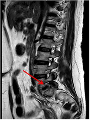 Spondylodiscitis After Surgery for Pelvic Organ Prolapse: Description of a Rare Complication and Systematic Review of the Literature